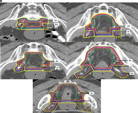 A B Axial Ct Scans Illustrating Differences Between Lorchel Et Al Download Scientific Diagram