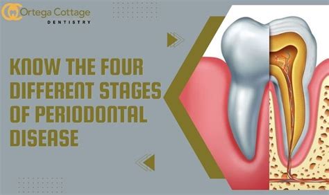 Periodontal Disease Definition Various Stages San Juan Capistrano