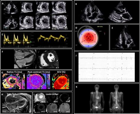 Red Flags Of Cardiac Amyloidosis Ca A E Typical Echocardiographic