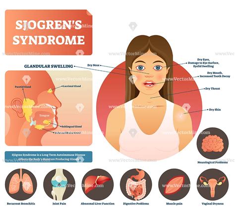 Sjogrens Syndrome Vector Illustration Infographic Diagram Sjogrens