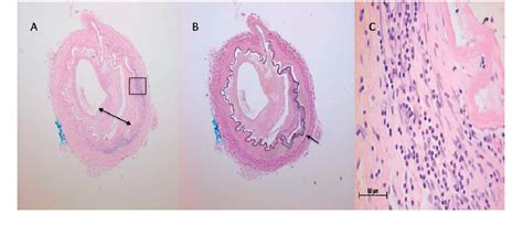 Figure From Vessel Wall Enhancement On Mri In The Diagnosis Of