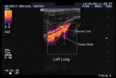 Lung Ultrasound And The Blue Protocol Crashing Patient