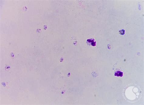 Thick Smear Plasmodium Vivax