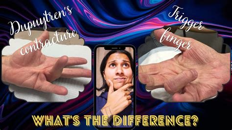 Dupuytren S Contracture Vs Trigger Finger Youtube