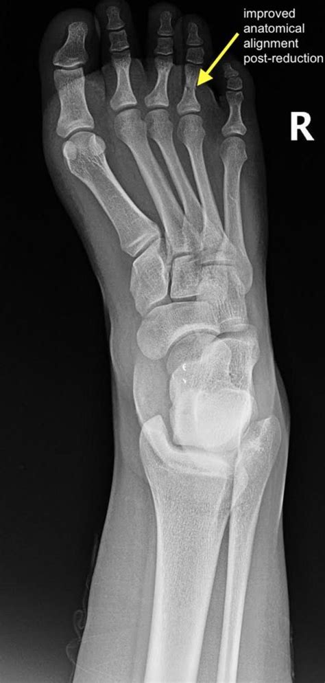 Proximal Phalanx Fracture of the Foot. XRay Postreduction, Annotated ...