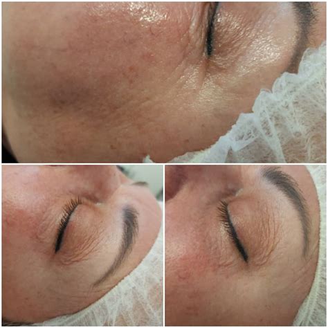 NewLife Aesthetics Clinic Global Eyecon Treatment Raynes Park