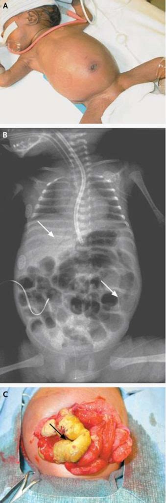 Necrotizing Enterocolitis Causes Signs Symptoms Prognosis Treatment