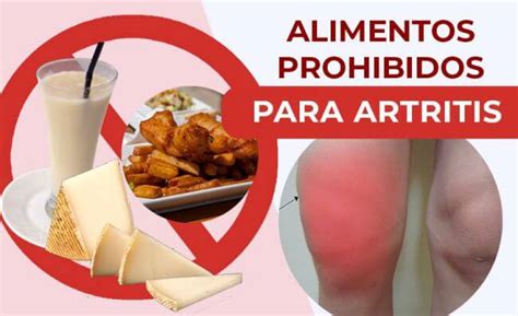 Alimentos Que Se Deben Limitar O Evitar Con Artritis Búscalo Aquí