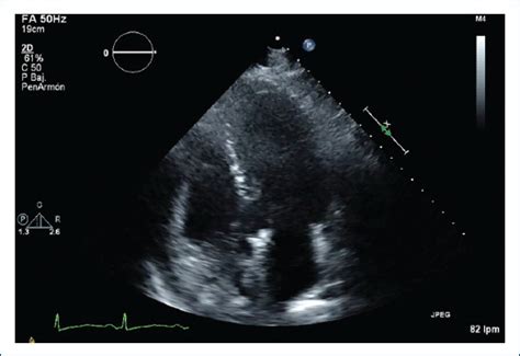 Síndrome de takotsubo en paciente con isquemia arterial aguda de