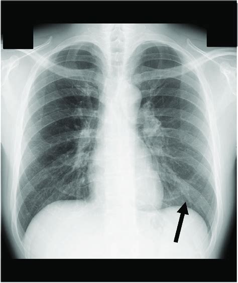 Bronchitis Lung X Ray