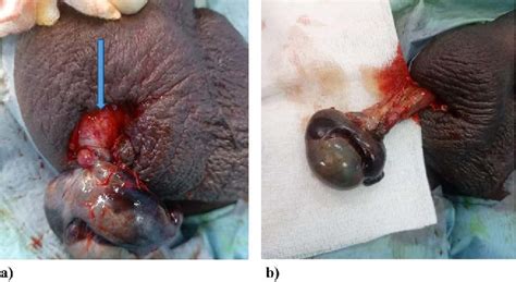 Figure 1 From Prevalence And Management Of Spermatic Cord Torsion SCT