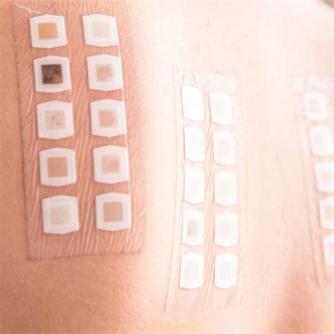 Patch Testing For Allergies Contact Dermatitis Eczema Rashes