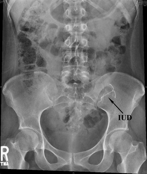 Extrauterine Migration Of A Mirena® Intrauterine Device A Case Report