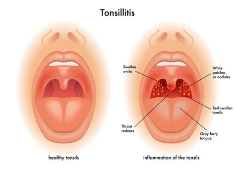 Chlamydia Throat Treatment