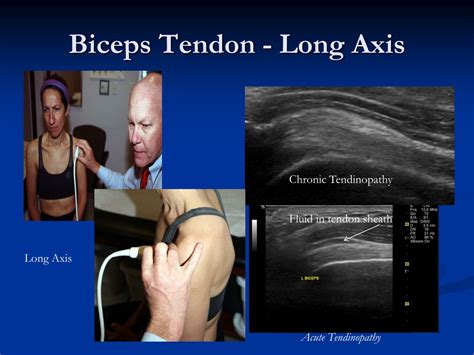 Ppt Intro To Musculoskeletal Ultrasound Of The Shoulder Powerpoint