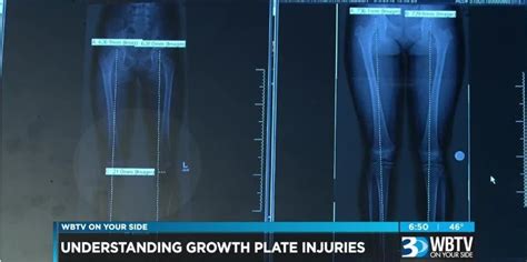 Understanding Growth Plate Injuries Orthopedics Orthocarolina