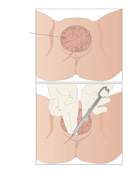 Episiotomy Artwork Photograph By Peter Gardiner