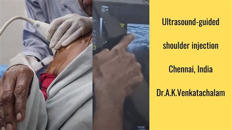 Ultrasound Guided Shoulder Injection Chennai India YouTube