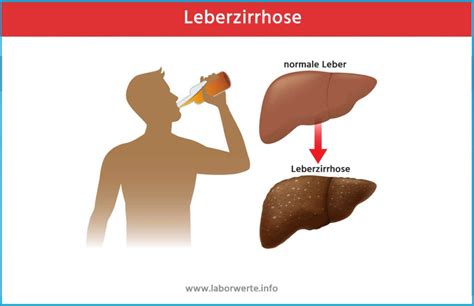 ᐅ Leberzirrhose Ursachen Behandlung Symptome erkennen