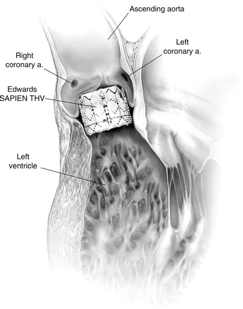 Figure From Percutaneous Balloon Expandable Aortic Valve Implantation