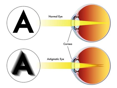 Astigmatism | Invision Optometry