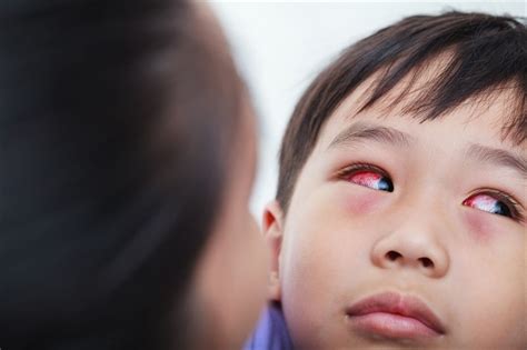 Conjunctivitis Causes Symptoms And How To Find Relief