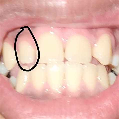 Please Help My Gum Is Swollen Over My Back Molar Is This Possibly A