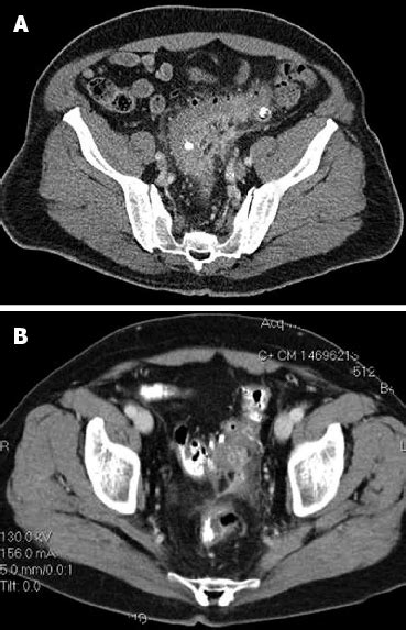 Computed Tomography Imaging Demonstrating Acute Diverticulitis A