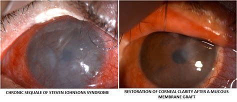 Cornea Eye Treatment Advanced Care For Corneal Conditions