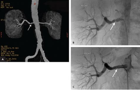 Radiologic Evaluation Of Suspected Renovascular Hypertension Aafp