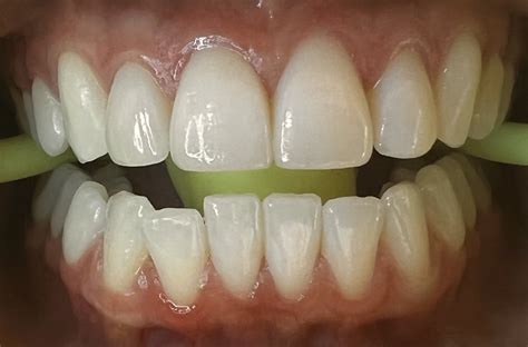 Teeth Whitening - POLISHED STUDIO