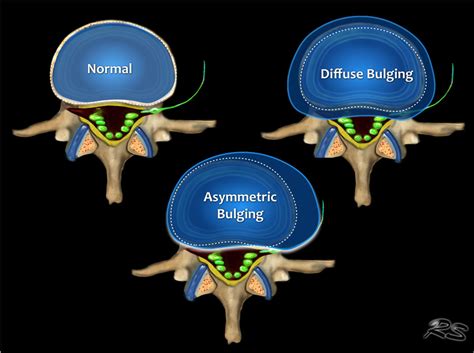 Bulging Disc Lumbar Spine MRI