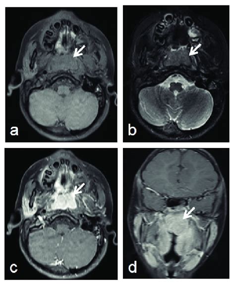 Axial Fat Saturated T1 A Axial T2 B Weighted Images Show A Solid