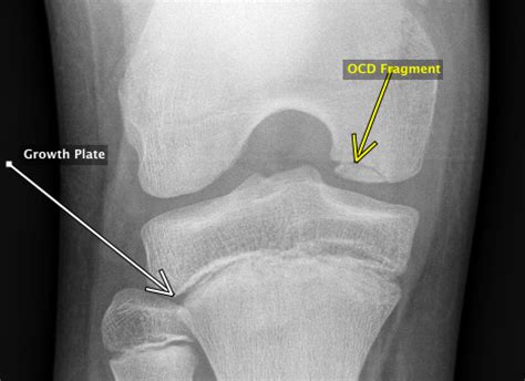 Osteochondritis Dissecans After Surgery