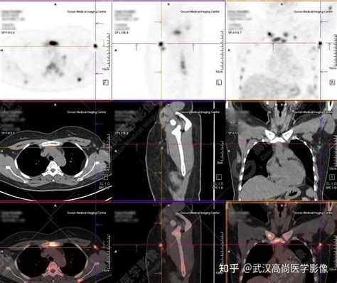 年轻女性乳腺癌在国内有明显上升趋势「武汉高尚医学影像」 知乎