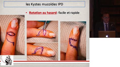 Arthrose De La Main Larthrose Ipd Et Arthrod Se Youtube