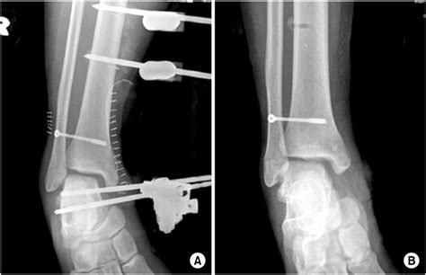 Checkrein Deformity By Incarcerated Posterior Tibial Tendon And