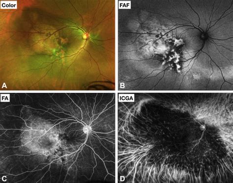 Choroidal Melanoma Fluorescein Angiography