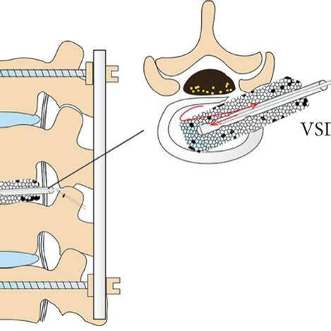 Percutaneous Screw Fixation With Transforaminal Debridement And Vacuum