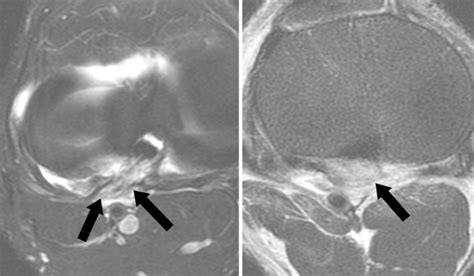 Popliteofibular Ligament Mri