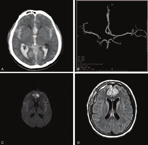 A Brain CT Scans On Admission Showed A Thick Subarachnoid Hemorrhage