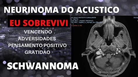 Neurinoma do Acústico Schwannoma do vestibular Eu Sobrevivi