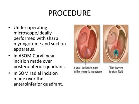 Myringotomy And Grommet Insertion