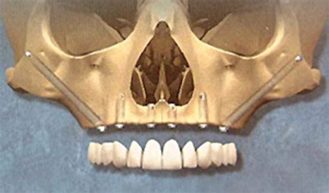 Teeth Replacement With Zygomatic Implants In Poor All On 4 Clinic