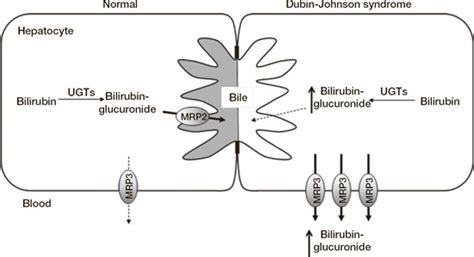 Schematic Representation Of DubinJohnson Syndrome Left Panel Under