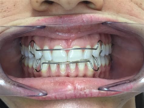 La Importancia De Los Retenedores De Ortodoncia Atauri Cano Dental