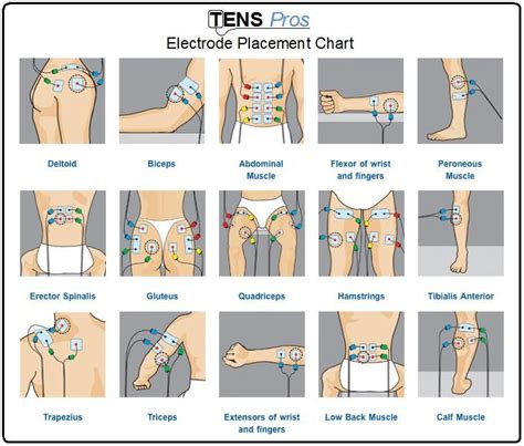 1000+ images about TENS Unit placement charts on Pinterest | The ...