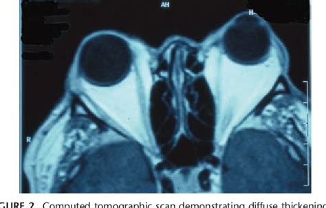 Foreign Body Removal by Inferior Meatal Antrostomy | Semantic Scholar