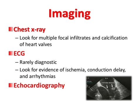 Infective Endocarditis