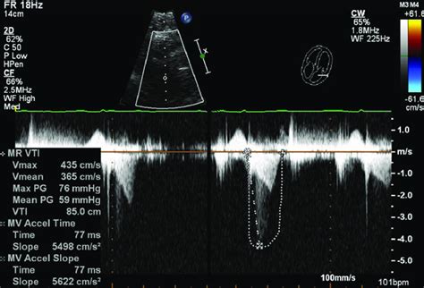 Transthoracic Echocardiogram Showing Outflow Tract Obstruction With A